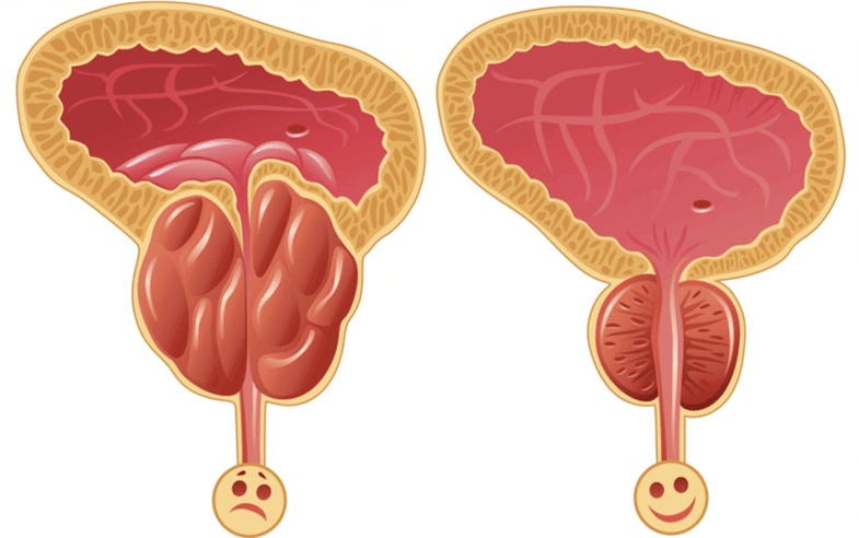 przyczyny problemów z potencją u mężczyzn